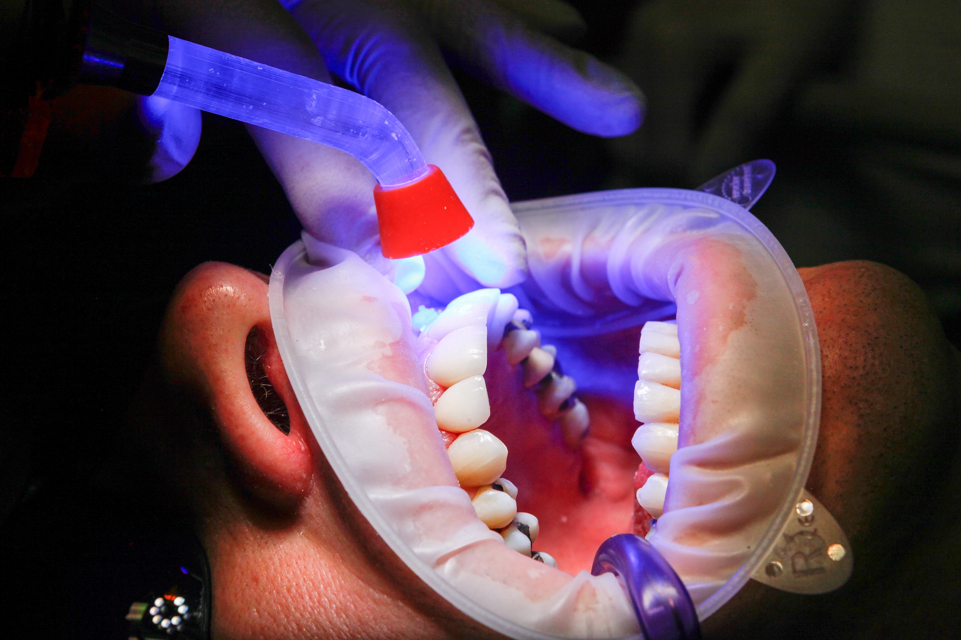 Gum Disease Treatment Houston