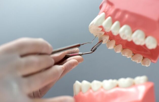 Tooth Extraction In Houston
